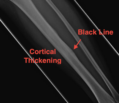 Tibial Stress Fracture 2